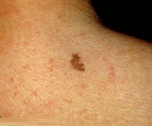 نویدی تازه برای درمان سرطان پوست نویدی تازه برای درمان سرطان پوست