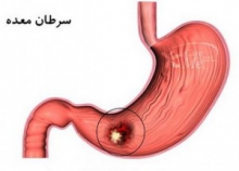  دلیل افزایش سرطان معده در ایران