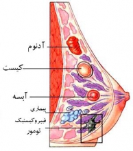 تشخیص درست در مرحله نخست بیماری است