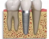 ایمپلنت دندان بایدها و نبایدها
